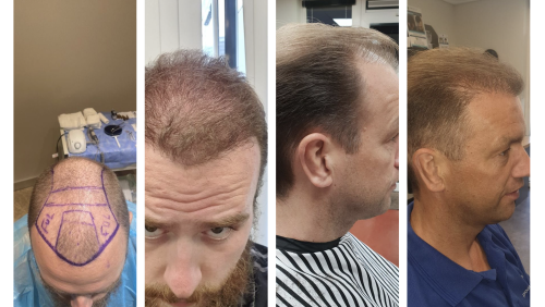 Haartransplantatie-via-Wills-Hairstyling-Barbershop